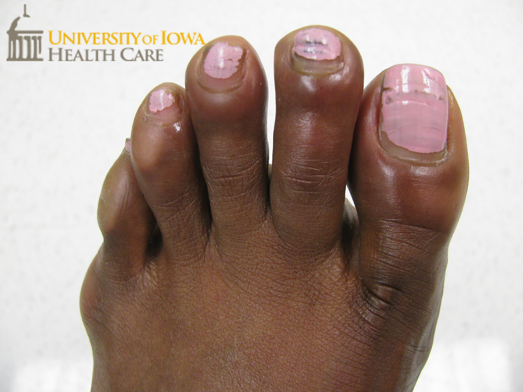 Erythema and edema of the toes. (click images for higher resolution).